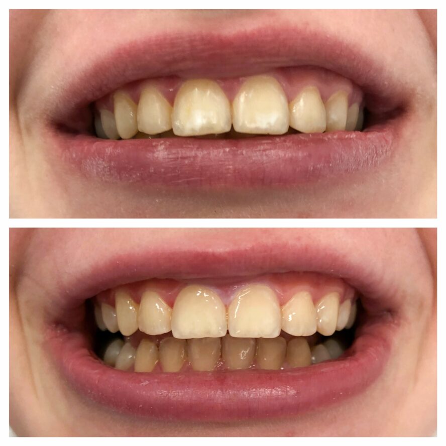 Czym są białe plamy na zębach i jak je leczyć?