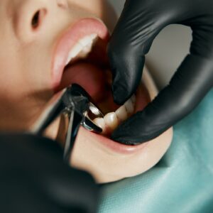 Do czego może doprowadzić usuwanie zdrowych zębów, w celu zastąpienia ich sztucznymi? (BEZ POTRZEBY)